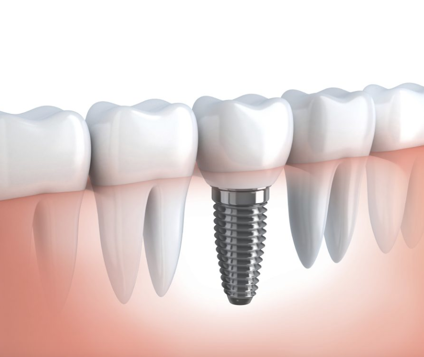 Dental Implants