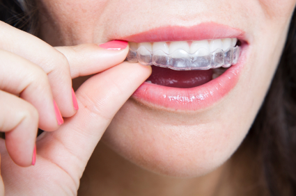 A Convenient Way to Align Your Teeth Using Invisalign